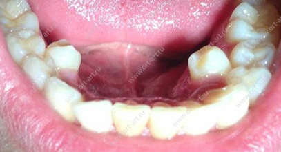 Сверхкомплектные зубы пример