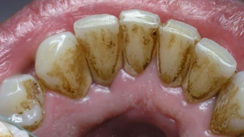 черные зубы с внутренней стороны