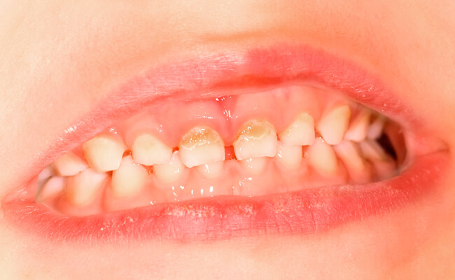 Фото начального кариеса молочных зубов