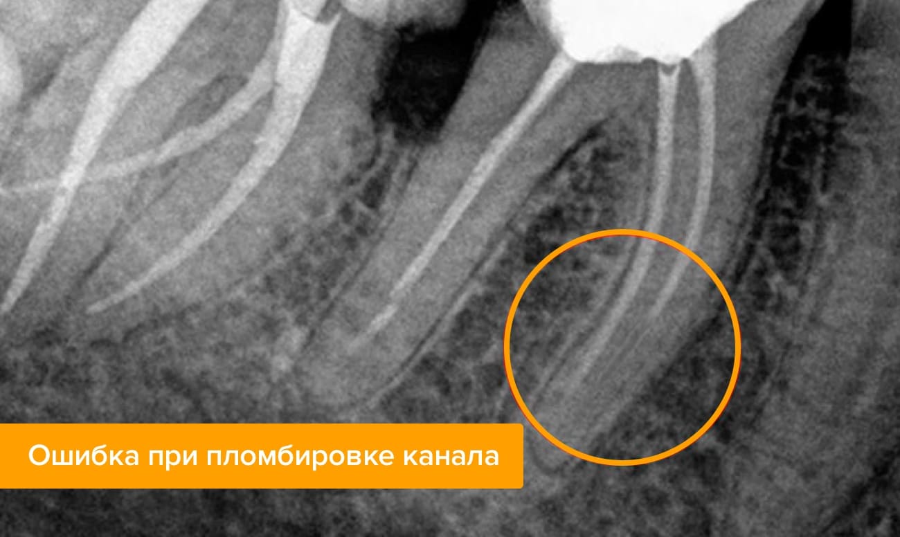 Ошибка при пломбировке канала на рентгене