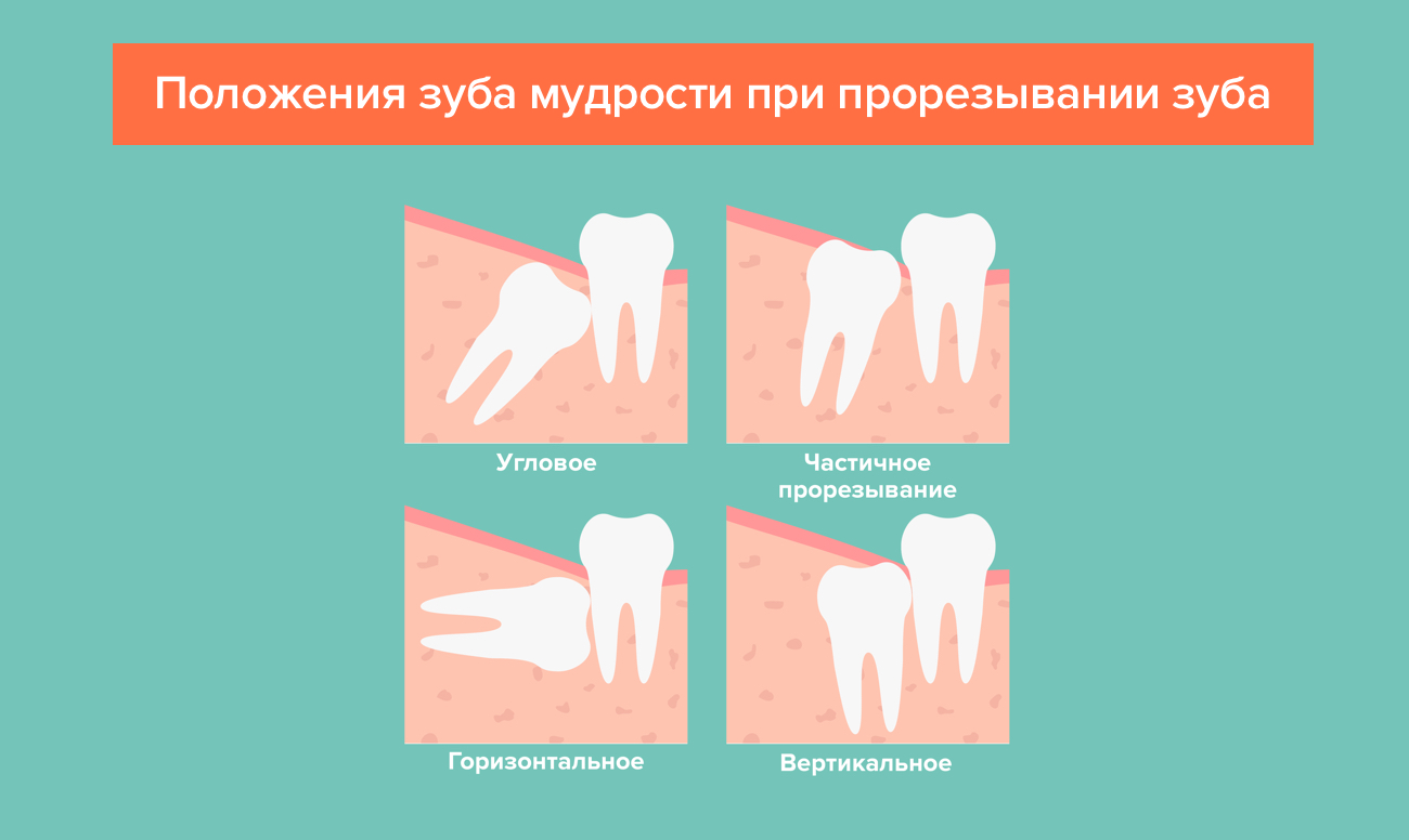 Положения зуба мудрости при прорезывании зуба в картинках
