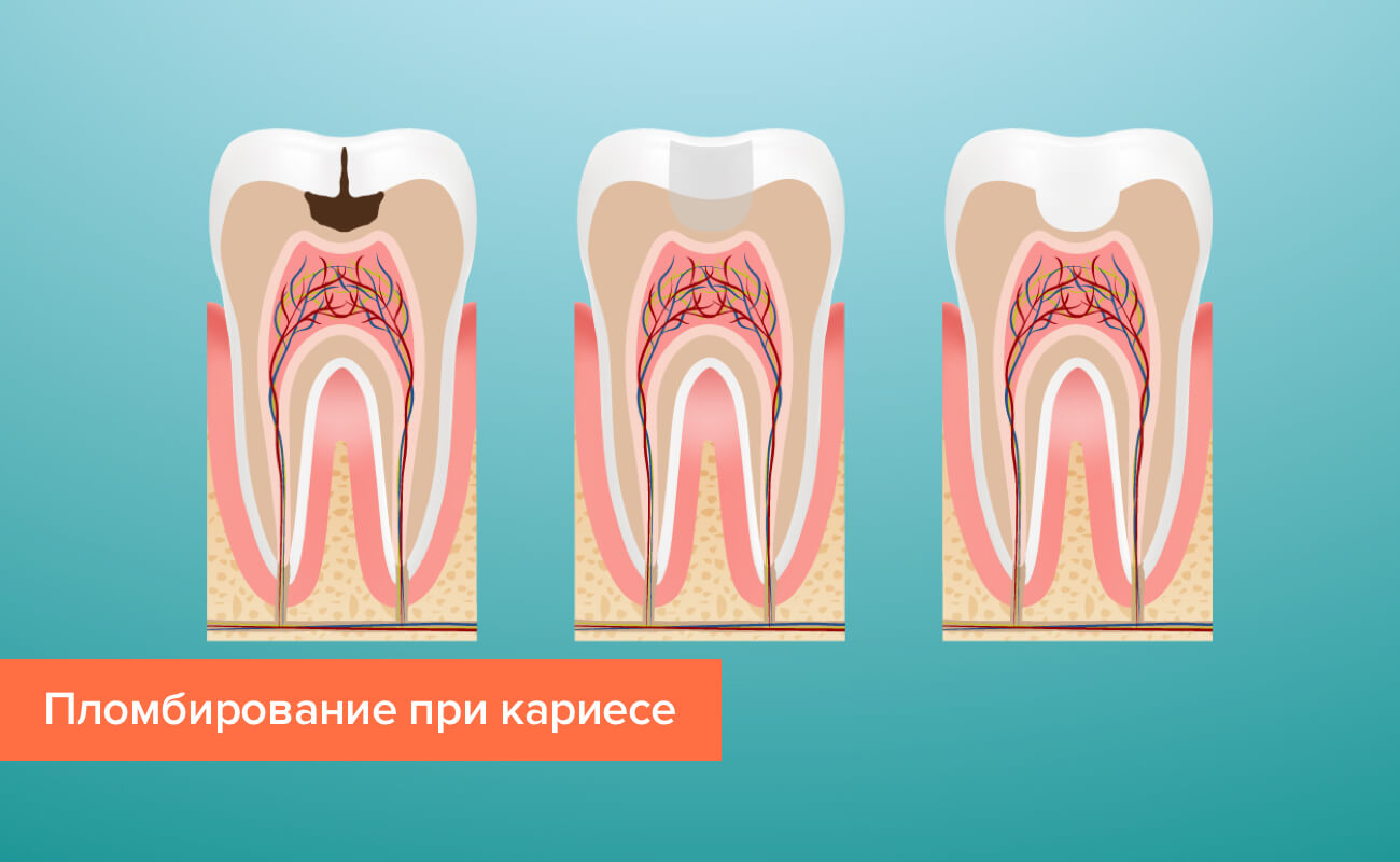 Пломбирование зубов при кариесе без удаления нерва в картинках