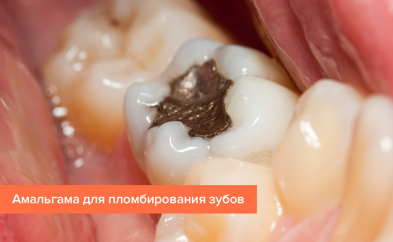 Фото зуба запломбированного амальгамой