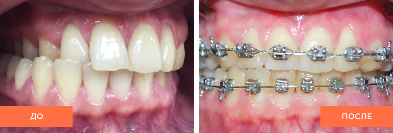 Фото пациента до и после исправления перекрестного прикуса брекетами