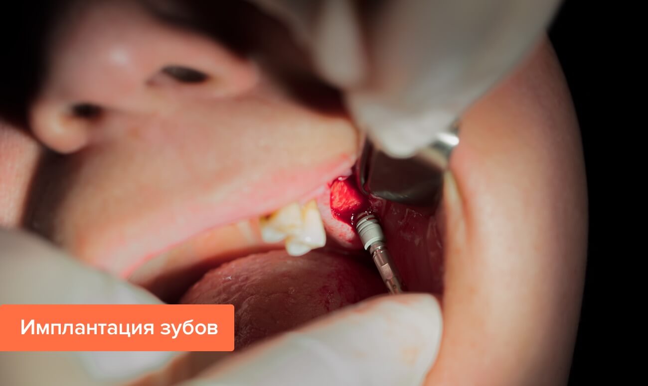 Фото процесса имплантации зубов