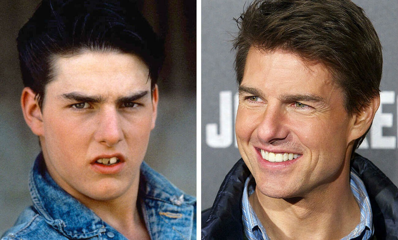 Зубы Тома Круза до и после лечения