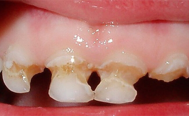 Фото циркулярного кариеса у детей на зубах