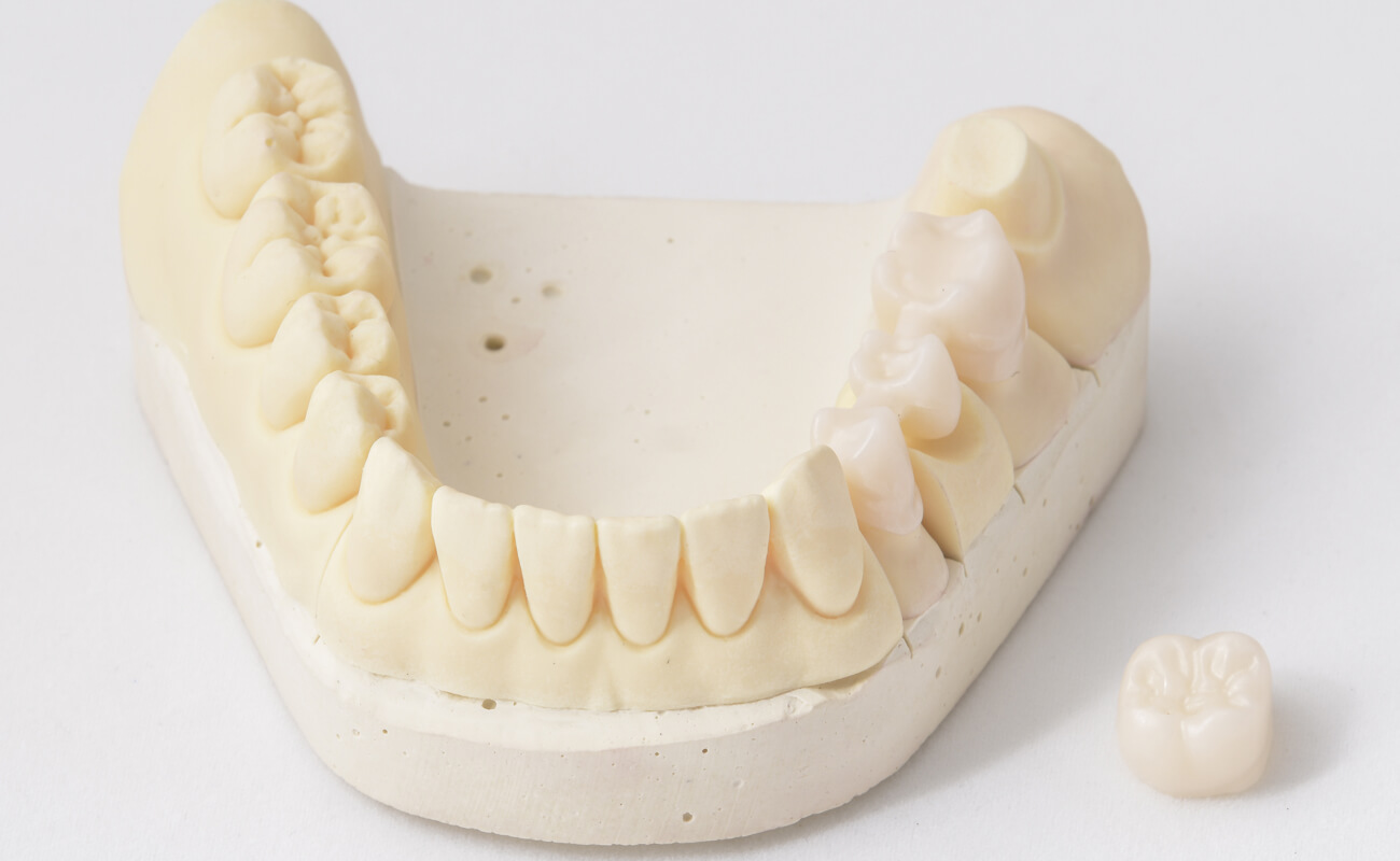 Фото зубных коронок из керамики на гибсовой модели