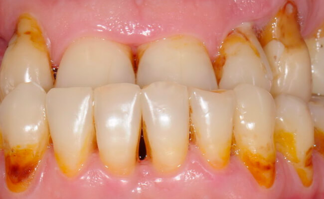Фото пациента с прикорневым кариесом передних зубов.