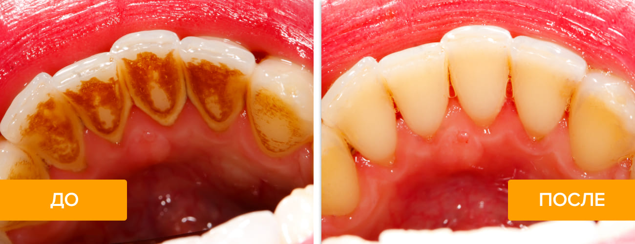 Фото зубов до и после чистки у стоматолога