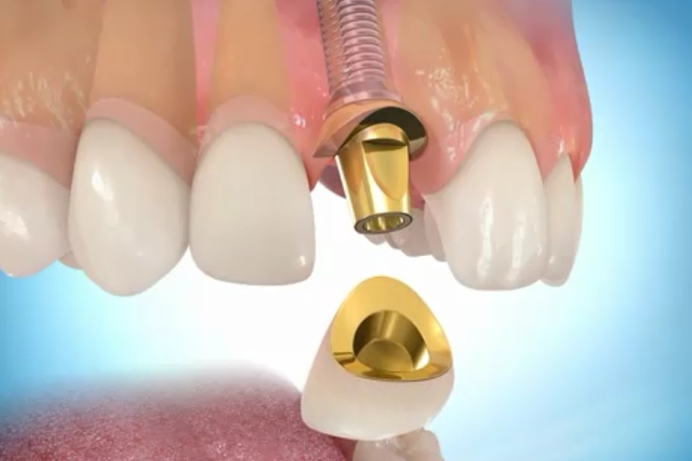 Ограничения после имплантации зуба