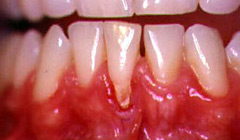 gingival recession