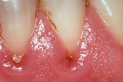 болезнь зубов и десен