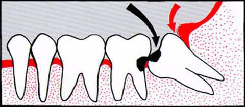 зубы нижней челюсти