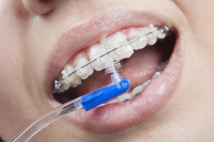 как чистить брекеты зубной щеткой