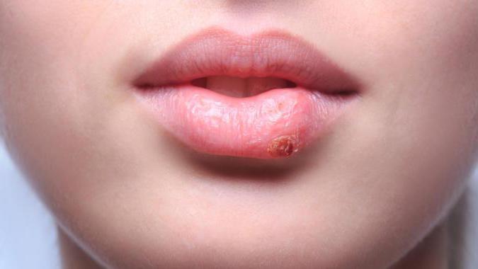болезни губ симптомы 