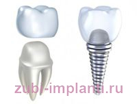 имплантация или протезирование зубов