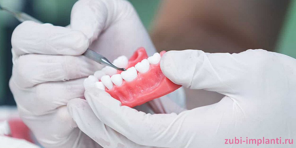 Протезирование зубов - когда выбрать