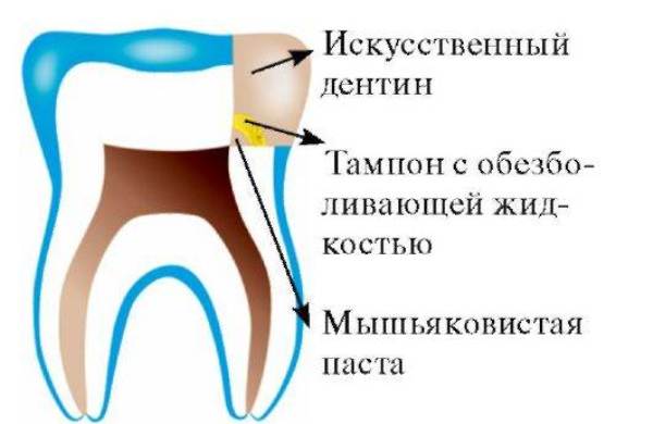 как установить мышьяк в зуб