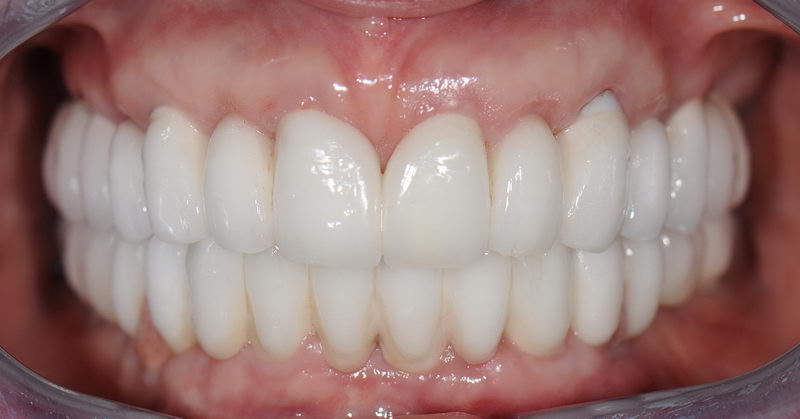 Коронки на передние зубы