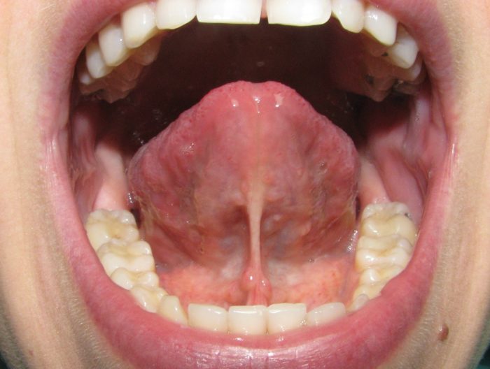 Болит под языком - как убрать боль и что делать?