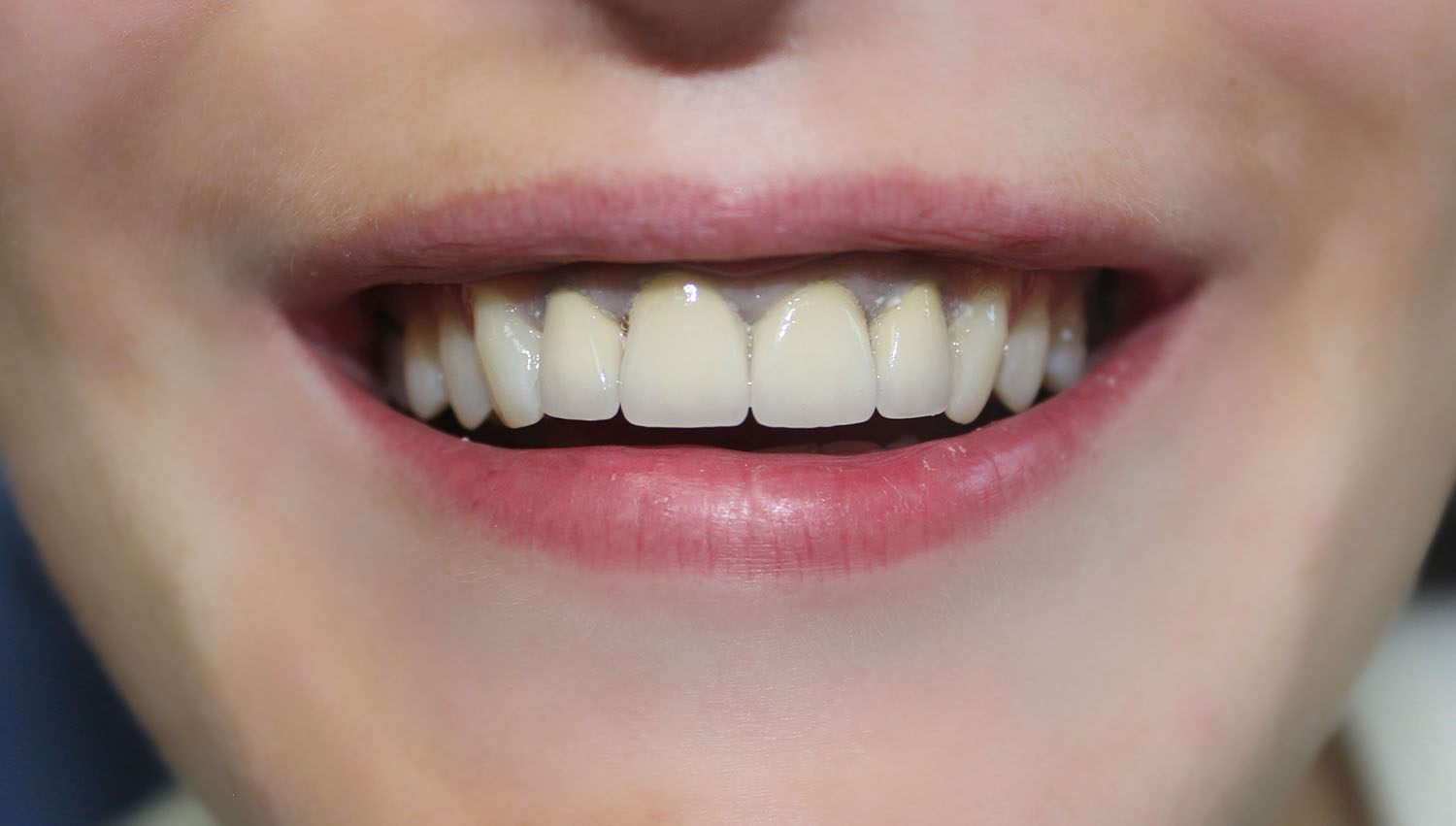 Коронки на передние зубы
