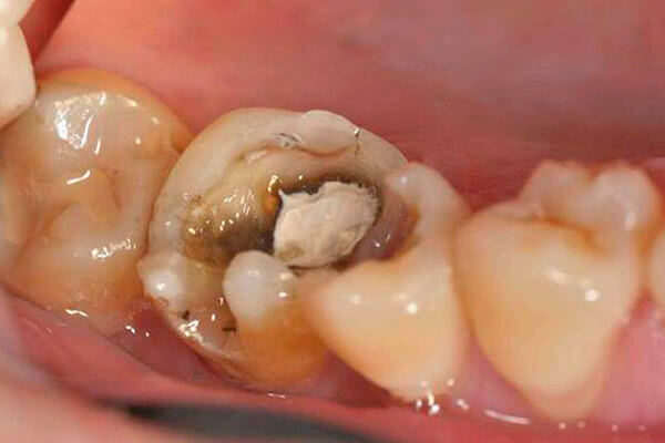 мышьяк в зубе
