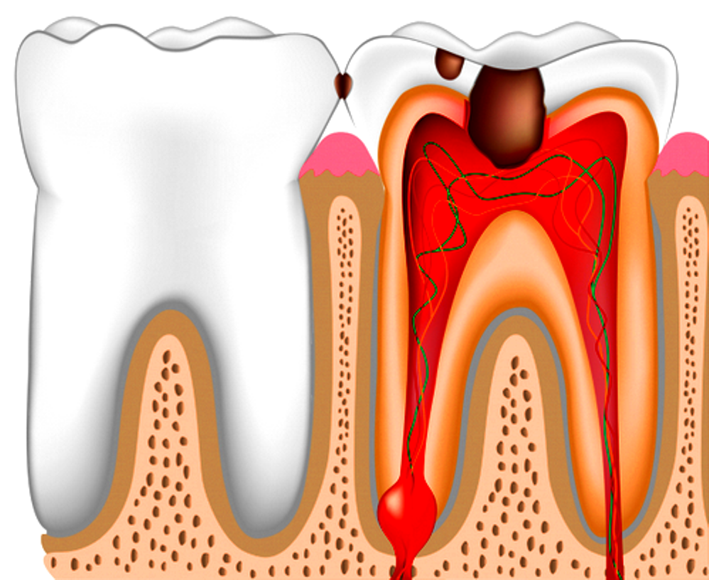Оголенный нерв зуба: что делать?