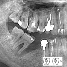 Состояние костной ткани вокруг корня зуба
