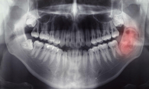 Снимок гранулемы зуба - рентген
