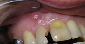Гранулема зуба - заболевания стоматологические