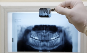 Гранулема зуба - как определяют и лечат