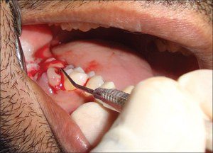 Лечение гранулемы у стоматолога