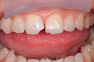 Боль в зубе может быть из-за скола зуба