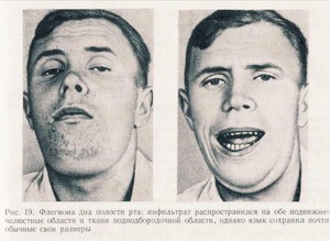 Флегмона дна полости рта-лечение