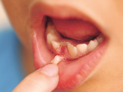Как вытащить шатающийся молочный зуб