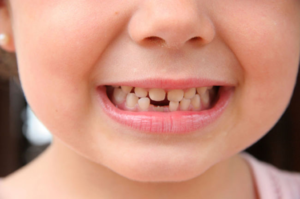 В детстве постепенно вырастает 20 молочных зубов