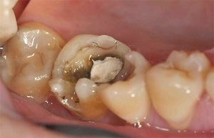 Установка мышьяка в зуб - причины и сроки