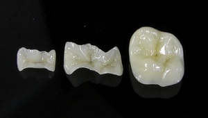 Основные разновидности зубных протезов