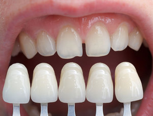 Описание особенностей виниров для зубов