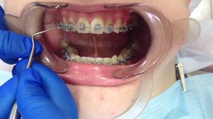 Методы выравнивания зубов в ортодонтии