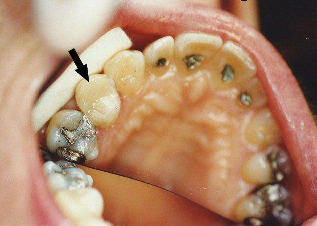  зубные пломбы