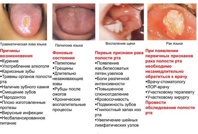 Развитие рака языка и ротовой полости