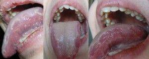 боковые травмы языка