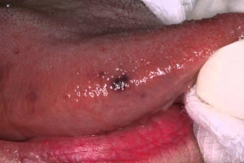 Кровоизлияние в ткани языка