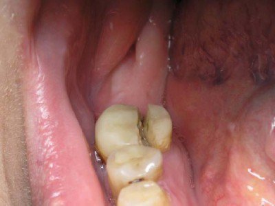 Сломанный зуб травмоопасный