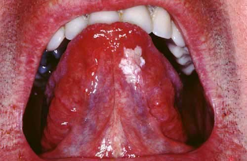 Лейкоплакия под языком - белое пятно