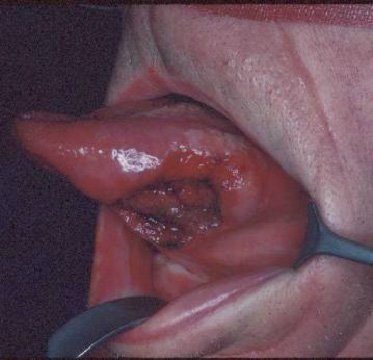Раковая опухоль под языком