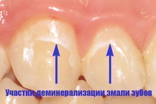 Истончение зубной эмали