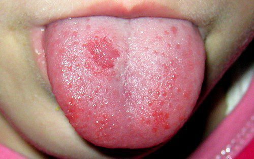 Аллергия на языке в виде сыпи и пятен